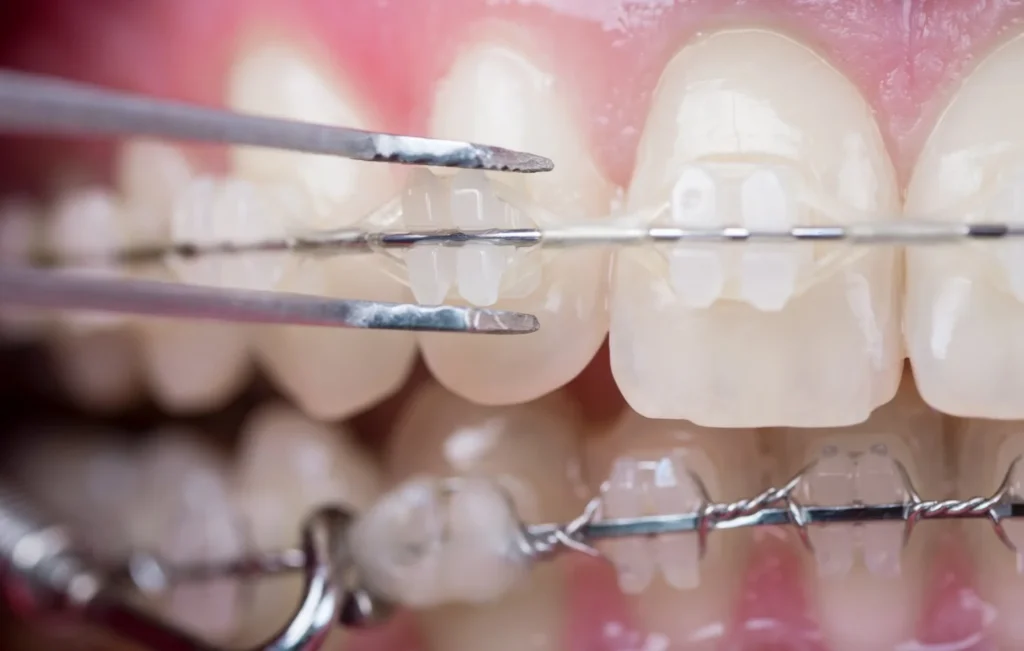 Ceramic braces